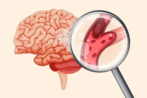Stroke Surgery