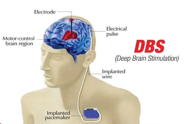 Deep Brain Stimulation